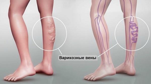Варикоз во время беременности Варикоз во время беременности