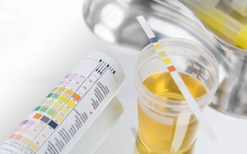 How to take a general urinalysis1