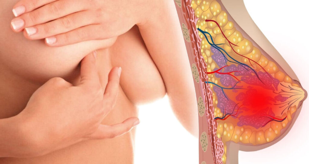 Breast pain after conception2