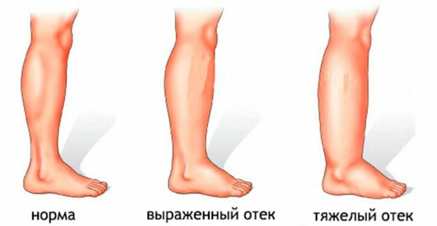 Отеки ног не проходят после родов что делать Отеки ног не проходят после родов что делать thumbnail